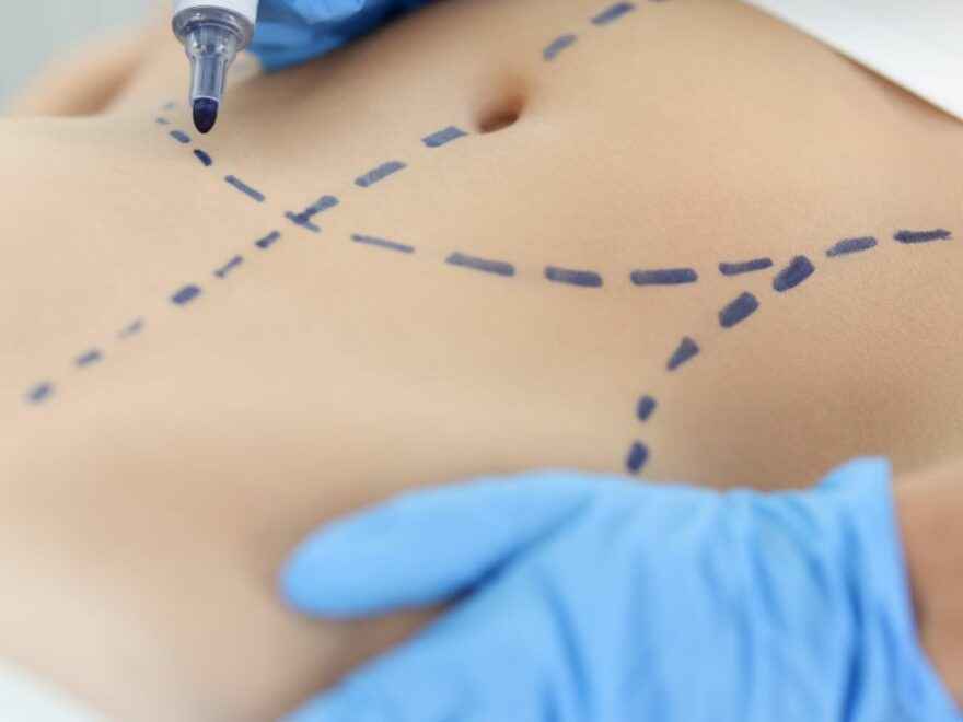 Para quem a abdominoplastia é recomendada