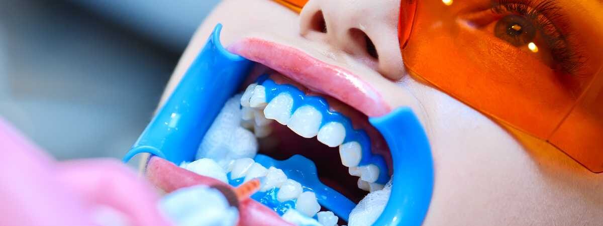 Clareador dental em gel é bom mesmo?