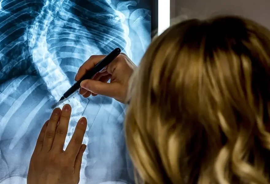 Quem tem escoliose pode pegar peso