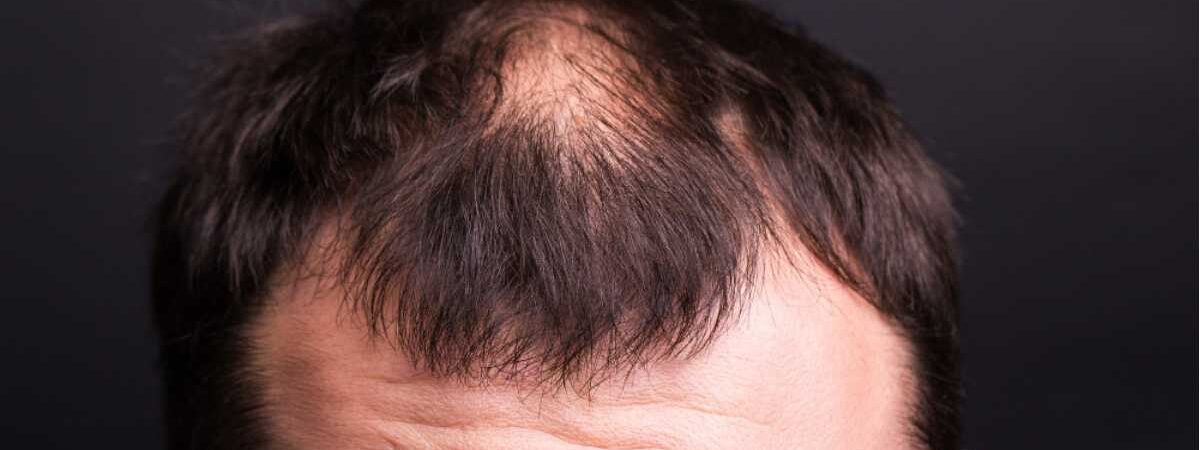 Queda de Cabelo Masculina: Causas, Como Evitar e Mais