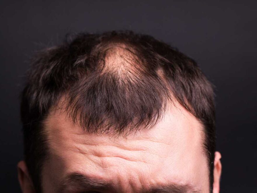 Queda de Cabelo Masculina: Causas, Como Evitar e Mais